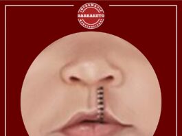 Operasi Bibir Sumbing