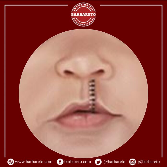 Operasi Bibir Sumbing