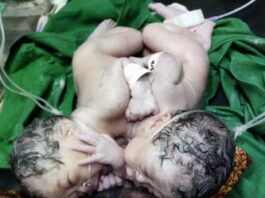 Bayi Kembar Siam Lahir