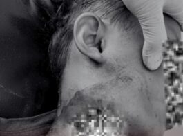 Gerombolan Anjing Liar Gigit Bocah Asal Sikur Hingga Tewas