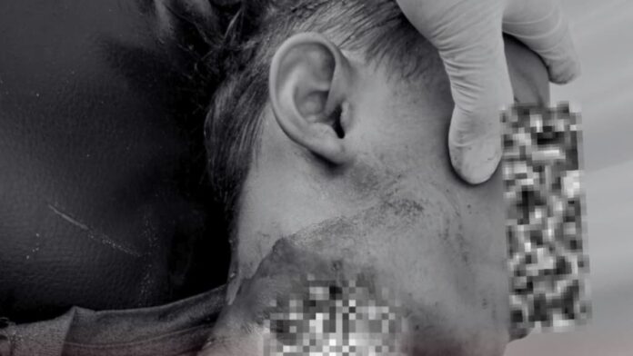 Gerombolan Anjing Liar Gigit Bocah Asal Sikur Hingga Tewas